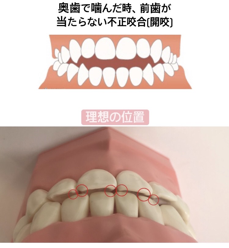 噛み合わせが悪いとどうなる 矯正以外の噛み合わせ治療は 神戸元町 県庁前 三宮の歯医者なら神谷歯科元町院