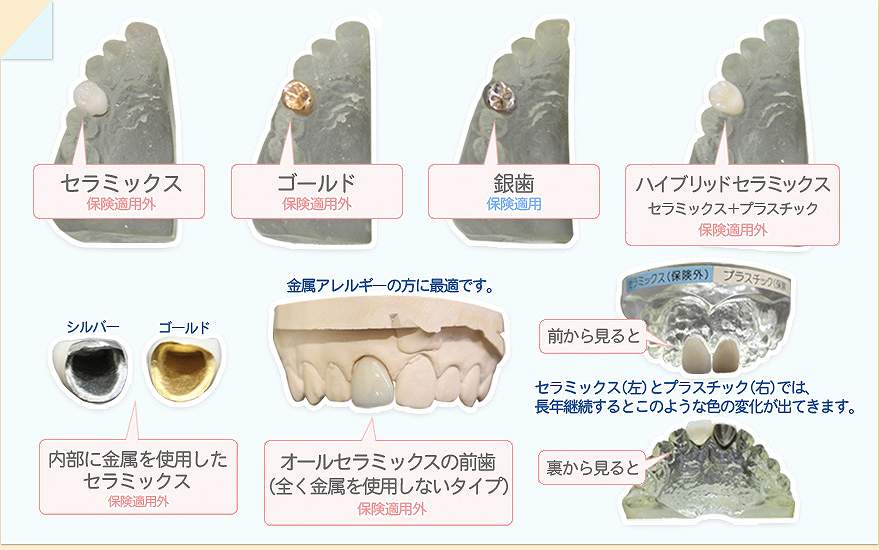 歯の詰め物の種類