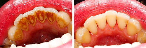 歯石除去の画像