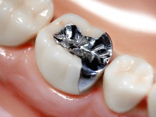 銀歯の詰め物の画像