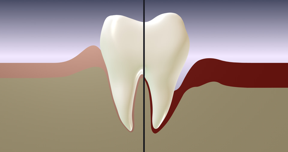健康的なはと歯周病が進行している歯の比較写真