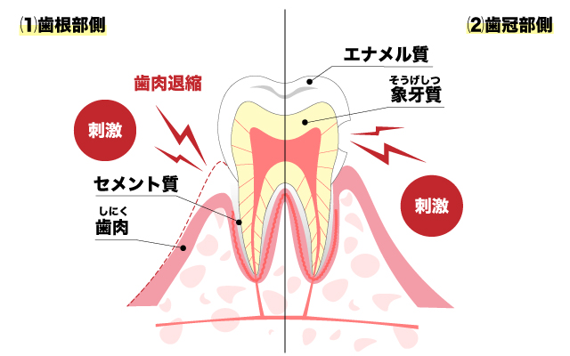 知覚過敏の歯の構造