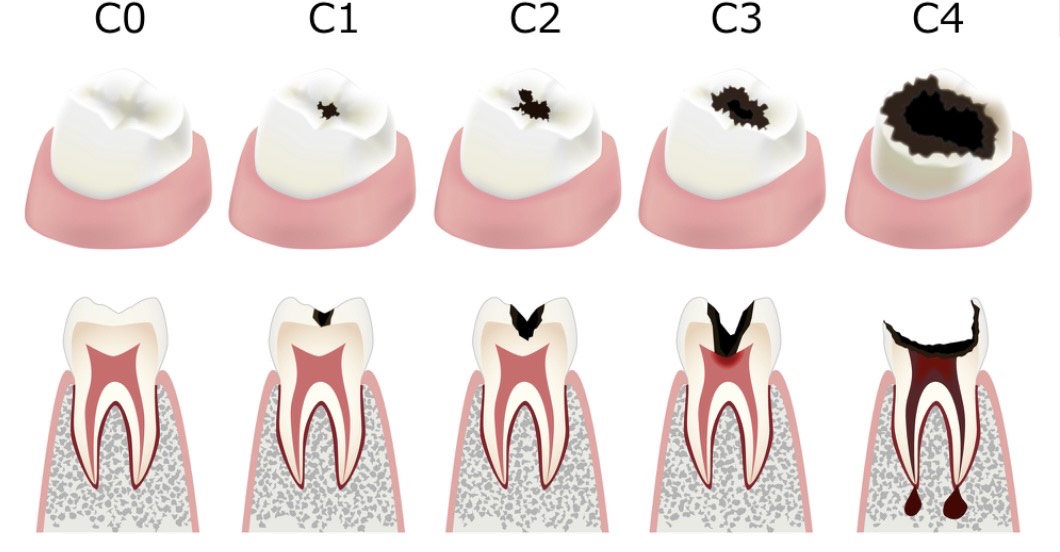 虫歯の進行レベル