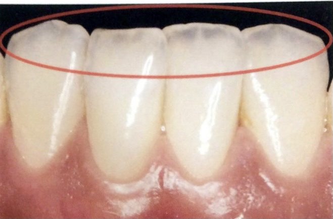 酸蝕歯で歯の先端や一部分が透けてみえる状態